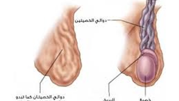أسباب وأعراض دوالي الخصية مراكز الرياض للخصوبة و الصحة الإنجابية